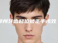 鄂州牙齿移位矫正手术效果更佳