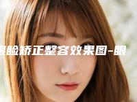 眼睑矫正整容效果图-眼睑矫正效果持久吗