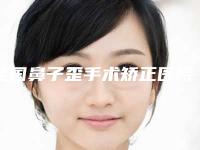 全国鼻子歪手术矫正医院上榜名单前二十位口碑榜更新了-实力杠杠的