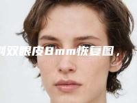 割双眼皮8mm恢复图,适合自己才是最美的~