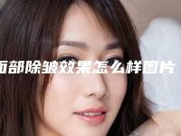 面部除皱效果怎么样图片(面部怎样除皱效果好)
